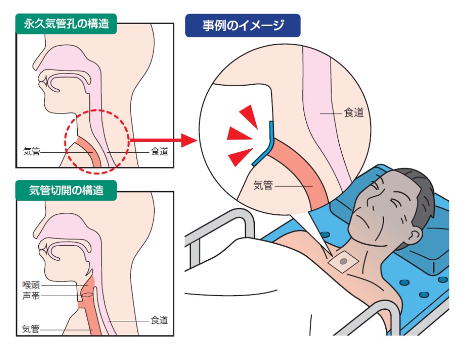 「永久気管孔」と認識せずにフィルムドレッシング材で患者頚部の孔を覆ってしまったため、呼吸が阻害される事例が発生